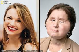 Youngest US face transplant recipient shares story of suicide survival and  hope