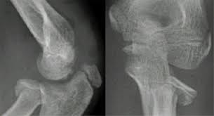 Definite treatment  open reduction with fixation  syndesmotic fixation  immobilization. Radial Head And Neck Fractures Pediatric Pediatrics Orthobullets