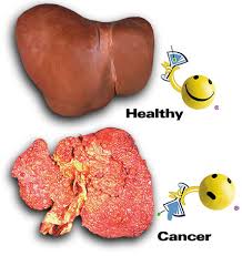 Cancer that spreads to the liver is more common than cancer that begins in the liver cells. Understanding Liver Cancer Symptoms And Types Liver Cancer Symptoms Liver Cancer Survival Blog