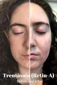 Über 7 millionen englischsprachige bücher. Tretinoin Retin A Before And After Acne Before And After Acne Tretinoin Acne Tretinoin
