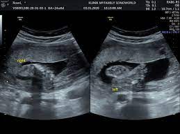 Untuk melakukan ct scan di rumah sakit, tentu anda harus membayar biaya yang tidak sedikit. Pregnancy Journey Buat Detail Scan Di Klinik Myfamily By Mysonoworld Emilinda