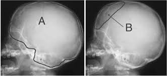 But the whole appearance was of a marvel in physical excellencies; Early Beaten Copper Pattern Its Long Term Effect On Intelligence Quotients In 95 Children With Craniosynostosis In Journal Of Neurosurgery Pediatrics Volume 1 Issue 1 2008