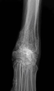 Or a dramatic, sudden fracture. Osteosarcoma In Dogs