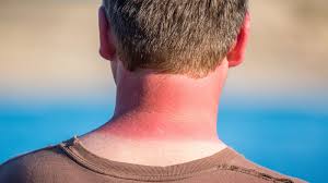 The waiter tried to soothe the angry customer. 5 Ways To Soothe Sore Skin If You Got Burnt In The Sun