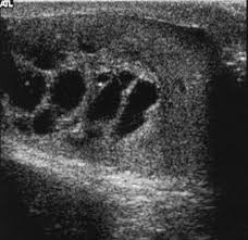 Partially replacing the right epididymis, this lump was consistent with a spermatocele. Benign Intratesticular Cystic Lesions Us Features Radiographics