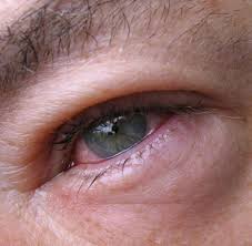 Cortison (von lateinisch cortex ‚rinde', schreibweise auch kortison) ist ein steroidhormon, das um 1935 in der nebennierenrinde des menschen gefunden wurde und auch synthetisch hergestellt werden kann. Cortison Nebenwirkungen Wann Das Medikament Gefahrlich Ist Welt