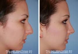 Excess Columellar Show Before And After Photo Gallery Nose Surgery Photos Patient 27 Nose Surgery Plastic Surgery Plastic Surgery Photos