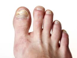 How To Get Rid Of Toenail Fungus Fast And Naturally Styles At Life