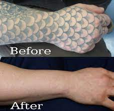 Heat delivered to the skin's pigment and surrounding tissue can leave visible scars where the tattoo used to be. Wavelengths Matter Tattoo Removal