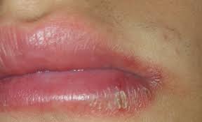 Offene stellen bitte immer mit einem herpespflaster abdecken, um komplikationen zu vermeiden. Ist Das Was Ich An Meiner Lippe Habe Wirklich Herpes