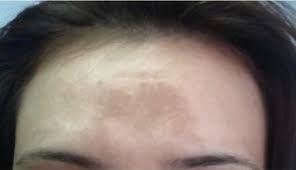 Culoarea pielii este data de o chimicala numita melanina, care produsa in exces in anumite zone, poate duce la aparitia de pistrui sau pete maronii. Pete Pe Fata De La Soare Tratament Despre ViaÈa Din Romania