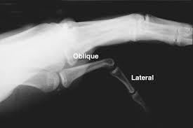 Image result for Lateral PIP Dislocation