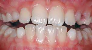 Gingivitis is a mild form of gum disease that happens when tartar and plaque buildup leads to bacteria infecting the gums. How Gum Disease Gets Started