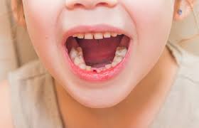 Loose Front Tooth What To Do Anchorage Pediatric Dentistry