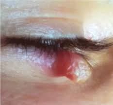 Image result for cornu cutaneum)