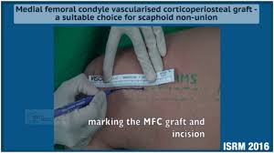 Check spelling or type a new query. Medial Femoral Condyle Vascularised Corticoperiosteal Graft Youtube