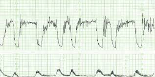 Image result for Late Deceleration