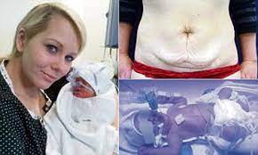 Knowing what to expect will help you in planning. Tummy Tuck Nearly Killed My Unborn Baby Daily Mail Online