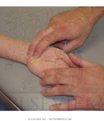 Image result for Carpal Compression Test