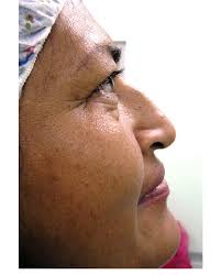 In a Mexican nose, the drooping tip or negative nasolabial angle can be... 