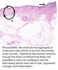 Pathology Outlines Pathologic Tnm Staging Of Melanoma Of