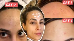 Repeat this process several times in a day. How To Get Rid Of A Pimple Fast Heal Scabs When You Ve Annihilated Your Skin By Picking Youtube