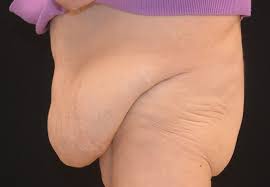 Getting insurance to cover your breast reduction surgery. Panniculectomy Akron Plastic Surgeons Of Akron