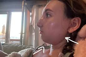 Woman bullied for 'looking like squirrel' has $200,000…