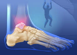 Use this tutorial to review the bones of the foot. Possible Death Of The Talus Bone Rock And Ice