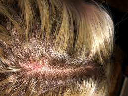 Skin cancer is one of the most common types of cancer. Skin Cancer On Scalp Photo Warning From Head Rush Hairdresser Falmouth Packet