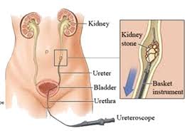 Retrograde Intrarenal Surgery Rirs Dr Nitin Negi In Jaipur Rajasthan