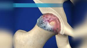 Woman Swallows Fish Bone That Migrates To Her Neck Requiring Surgery To Remove Health24