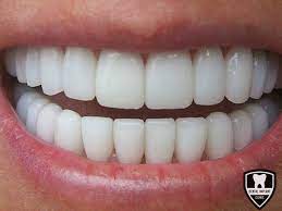 Yapılan diş kaplamasının kalitesi ve estetiği sadece. Zirkonyum Kaplama Dis Uygulamasi Nedir Nasil Yapilir Dental Implant Clinic
