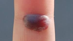It has the ability to help drain blood blister inside cheek when it is applied to it. Blood Blister Symptoms Causes Diagnosis