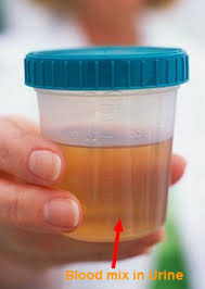 Missclinic Kidney Stone Symptom Check From Home Lupus Nephritis Polycystic Kidney Disease Awareness Medical Jobs