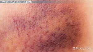 Image result for Contusion