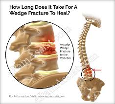 The implications of the injury vary, with a single break ligaments can also incur damage during the injury, which further weakens the stability of the joint and increases the healing time for a fractured ankle. How Long Does It Take For A Wedge Fracture To Heal
