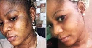 Cut a fresh lemon and squeeze the juice into a clean bowl. 11 Ways To Remove Dark Spots From Your Skin