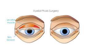 Are Your Droopyeyelids Ptosis Affecting Your Productivity Get Rid Of Unnecessary Headaches With The Help Of Asia Retin Droopy Eyelids Eye Health Eye Surgery