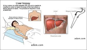 Biopsies are usually performed to determine whether tissue or a tumor is malignant (cancerous) or to determine the cause of an unexplained infection or inflammation. Liver Biopsy