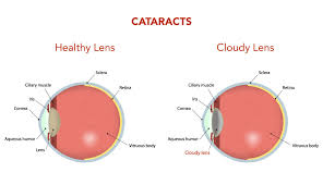 Image result for Cataract Extraction