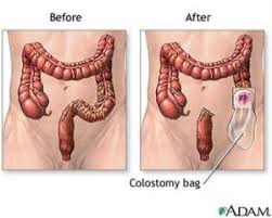 Image result for Enterostomy
