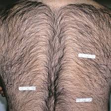 The truth behind the picosure lawsuit. Laser Hair Removal Treatment Cynosure