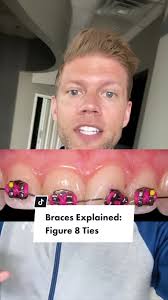 Braces Wires: Are They Supposed to Wiggle?