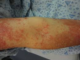 Pityriasis rosea, pityriasis rubra pilaris, and other papulosquamous and hyperkeratotic diseases. Pityriasis Rubra Pilaris