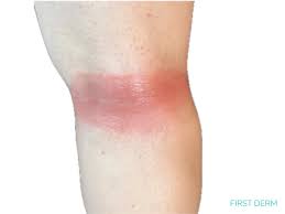Image result for allergy rash on the legs
