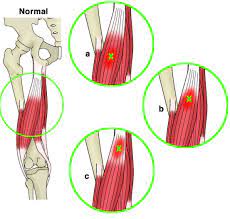 Rehabilitating Acute Hamstring Injuries El Paso Tx Doctor Of Chiropractic Soft Tissue Injury Hamstrings Hamstring Muscles