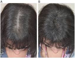Therefore, a search for treatable causes of telogen effluvium (eg, anemia, hypothyroidism), especially in patients with an abrupt onset or a rapid. The Role Of Mutations On Gene Ar In Androgenetic Alopecia Syndrome Medcrave Online