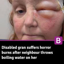 Disabled gran suffers horror burns after neighbour throws boiling water