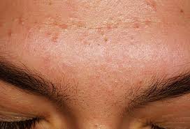 Hasil gambar untuk Types of Acne Treatment Solutions For Your Skin